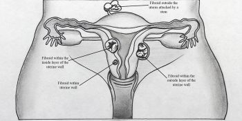 فیبروم‌های رحمی و راه‌های درمان